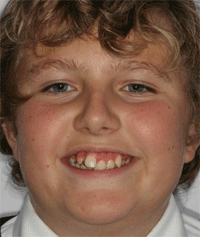 Wetherby Orthodontics | Teenagers