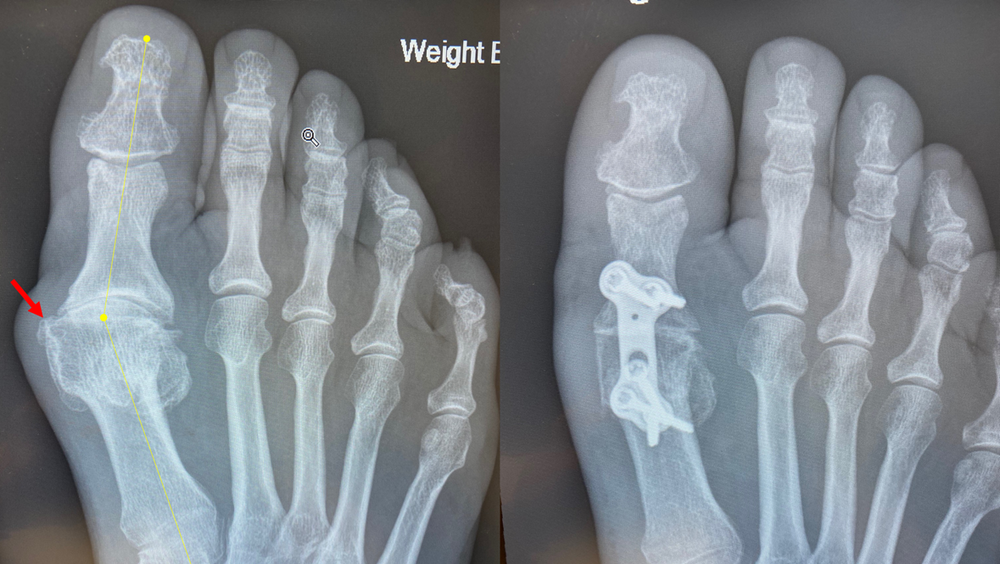 Does "bunion surgery" work?