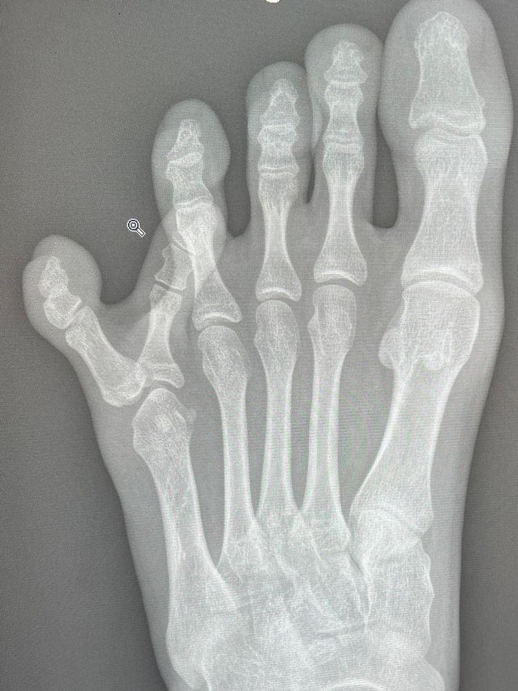 MORE THAN AN EXTRA TOE