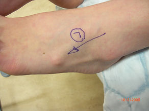 4.2.1 pre-post scarf clinical.png