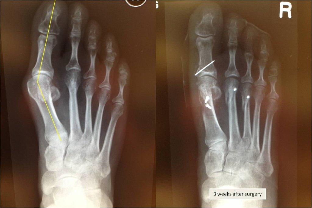 Bunion Surgery