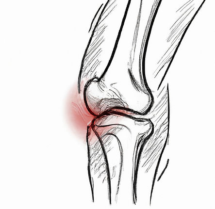 anterior cruciate ligament tear.jpg