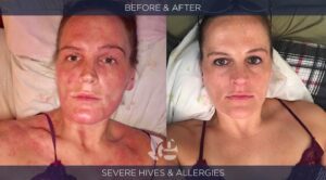 Hives before and after