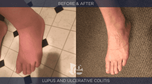 Lupus before and after