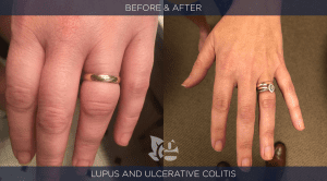 Serious Considerations Regarding Colonoscopies