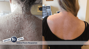 Enbrel allergic reaction