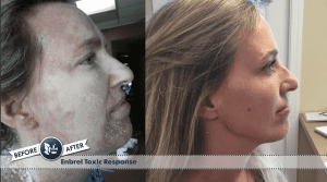 Enbrel allergic reaction