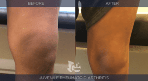 Juvenile Rheumatoid Arthritis