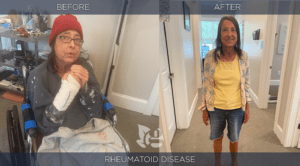 Rheumatoid Disease Before and After