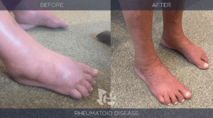 Rheumatoid Disease Before and After