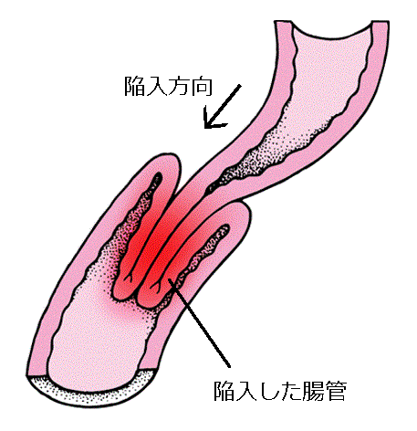 tyoujuuseki.GIF