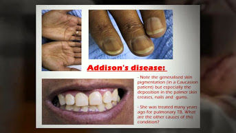 PT SOLID GOLD BERJANGKA | Apa Itu Addison