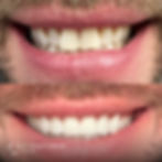 cosmetic veneers 2.jpg