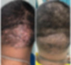 Folliculitis