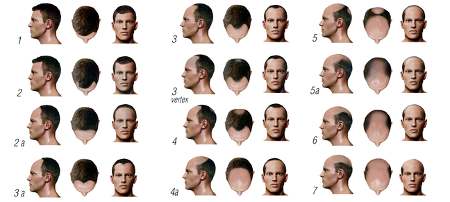 Stages of Male Pattern Baldness
