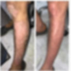 Psoriasis