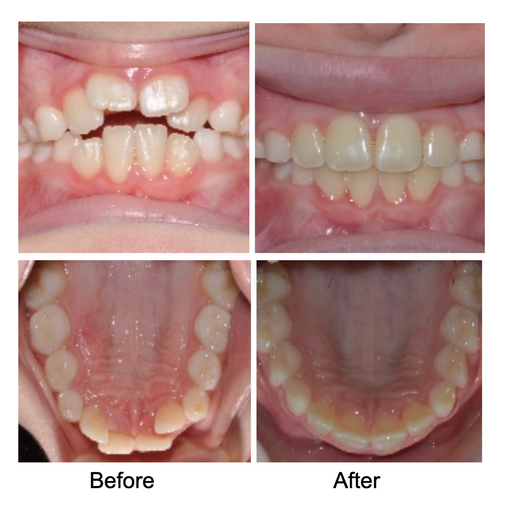 Orthodontist Lititz PA Lititz Orthodontics Clear Braces