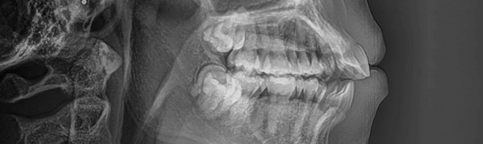 Modal6_Orthognathic Surgery_1501943739_1by4.jpeg