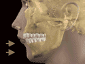 Retrognathism.webp
