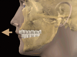 Dental Protrusion.webp