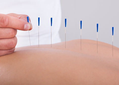 Acupuncture_edited.jpg