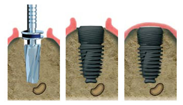 implantchir.jpg