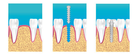 pose_implant-p.jpg