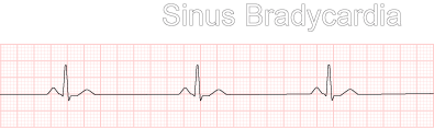 sinus_bradycardia.gif