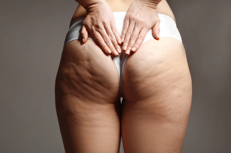 La cellulite touche 9 femmes sur 10