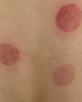 ic glutathion after ov ozone IV Therapy UK – Leicester & Midlands Experts Realigned transsulfuration drives BRAF-V600E-targeted