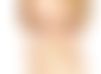 Laryngitis, Hoarseness and Vocal Blowout