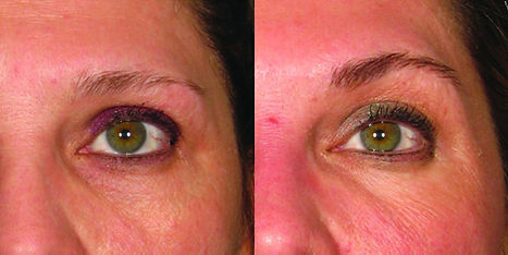ultherapy-84-front-detail.jpg