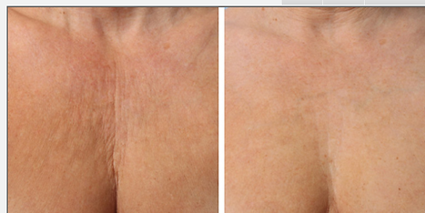 Ultherapy-Results-Chest.webp