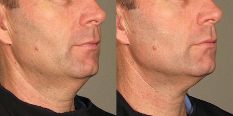 ultherapy-122-right-side-detail.jpg