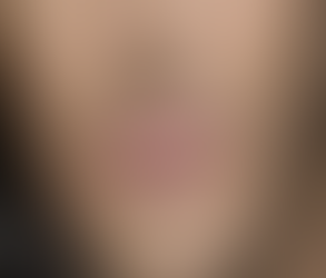 Can Smoker’s Lips Treatment Reduce Lip Wrinkles and Lines?