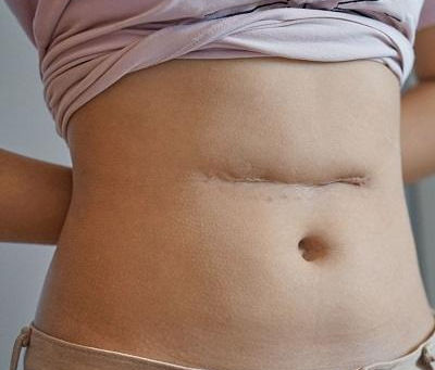 Can Scar Revision Surgery Restore Natural Skin Texture?