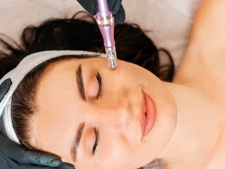 Can Dermapen Treat Fine Lines Around the Eyes?