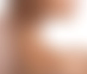 Is It Possible to Successfully Treat Old Surgical Scars?