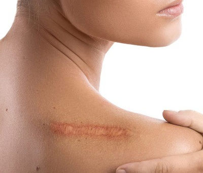 Is It Possible to Successfully Treat Old Surgical Scars?