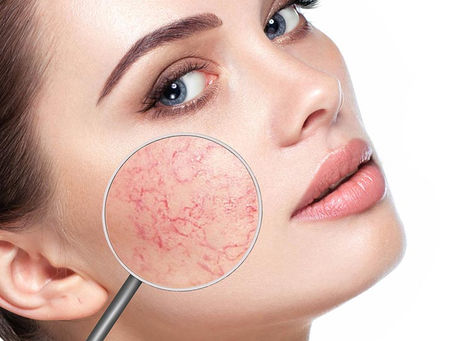 Can Facial Capillary Treatment Help Improve Skin Tone?