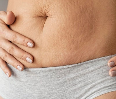 Can Abdominoplasty Help Fix Diastasis Recti?