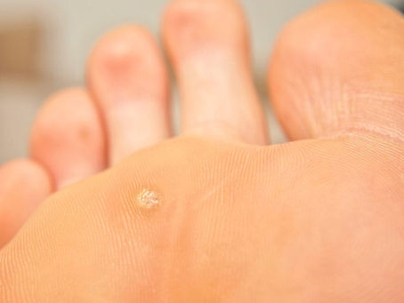 Is Wart Removal Safe for Sensitive Skin?