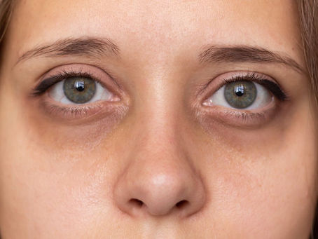 Are Dark Circles Common Among Young Adults?