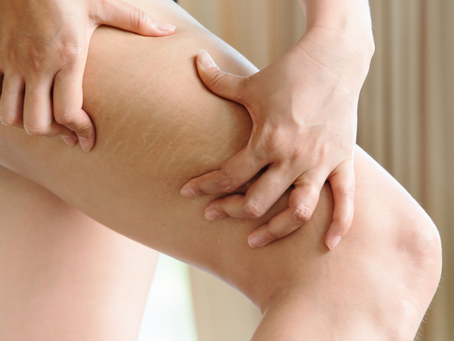 Which Treatment Works Best for Deep Stretch Marks?