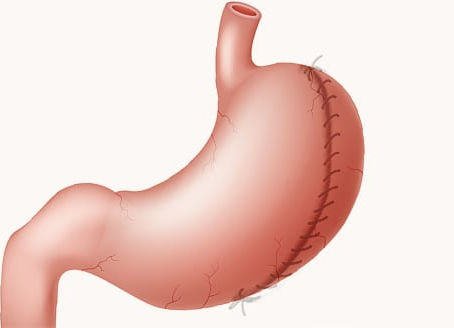 Can Gastric Plication Improve Blood Pressure?