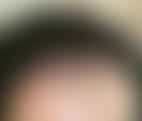 Can Female Hair Transplants Restore Hairline Shape?