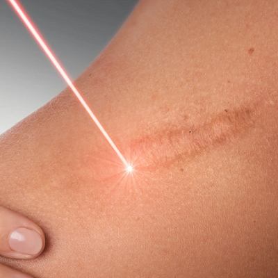 How Many Laser Sessions Are Needed for Scar Reduction?