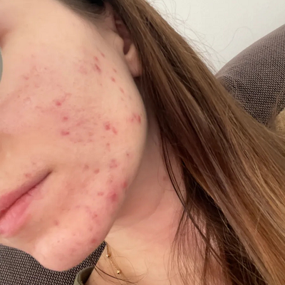 Does Acne Treatment Help Minimize Acne-Related Redness?