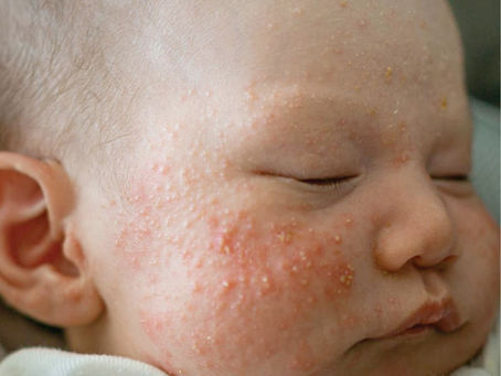 Are Milia Treatments Suitable for People with Darker Skin Tones?