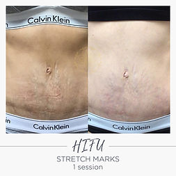 HIFU stretchmarks.jpeg
